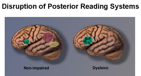 Understanding Dyslexia: Insights from Russell Van Brocklen